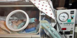 Suriyeli yapışık siyam ikizleri Ankara’ya getirildi