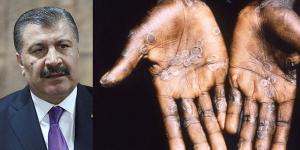 Maymun çiçeği Türkiye’de görüldü